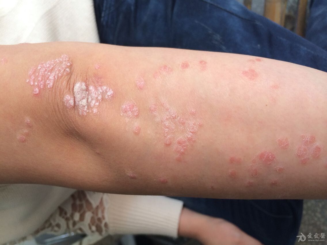 如何预防银屑病被诱发